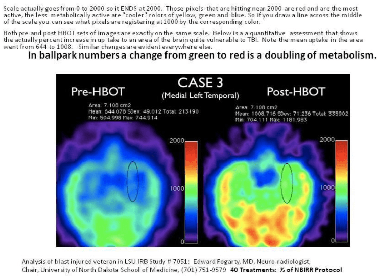 hbot 1.5 restores0 barin function and metabolism